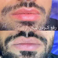 روشن سازی لب نچرال ، اسکالپ سر ، فیبروز ابرو نچرال