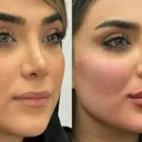 تزریق و آموزش ژل و بوتاکس و چربی،لیفت نخ