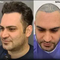 کاشت مو پرتراکم و طبیعی/قسط ۶ ماهه/تخفیف میلیونی