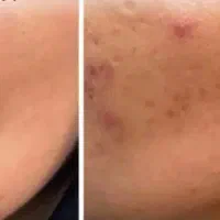 حذف آنی و سریع خال کک مک و لک