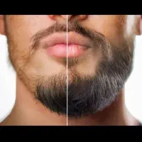 بدون کاشت و کمتر از یک ماه