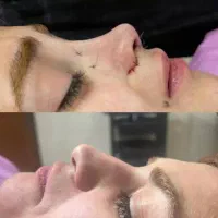 جراحی زیبایی بینی ۲۰الا۲۳ولیفت وساکشن دراهواز