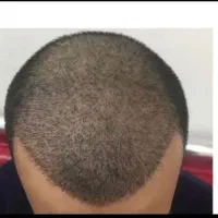 کاشت ابرو و مو به صورت اقساط