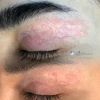 درمان بدون بازگشت خط بلفاروپلاستی واسکار جوش ،سالک