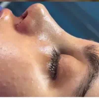 لیپوساکشن ، جراحی بینی ،لیفت