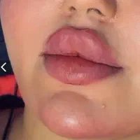 ژل بوتاکس فیلر مزو prp در مطب زیبایی خانم نامی