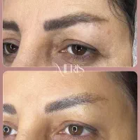 لیزر موهای زائد فقط ۵۹۰،لیزر رفع تیرگی،ریمو تتو