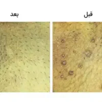 درمان زگیل تناسلی( اچ پی وی )پزشک متخصص دکتر رستمی