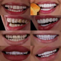 کامپوزیت دندان/لمینیت/دندانپزشکی