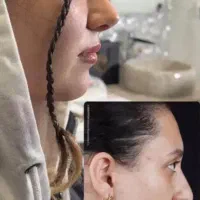 عمل بینی ساکشن کاشت مو غبغب ژل بوتاکس
