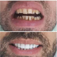 دندانپزشکی تعرفه دولتی/کامپوزیت/لمینت