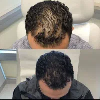 پی آر پی ممنوع