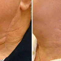 خداحافظی همیشگی با جای جوش و جای زخم و جای بخیه