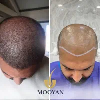 جشنواره‌کاشت‌مو(VIP)24 کاشت ابرو۱۴‌(اقساطی)