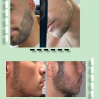 استرس داری واسه ریشات که در نیاد