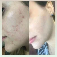پماد ایتالیایی تضمینی موجوده