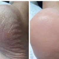 کرم ترک ویتابلا