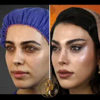 آفر مینی لیفت‌ شقیقه ابرو گونه‌ اندولیفت‌ بلفارو..
