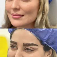 جراحی بلفاروپلاستی