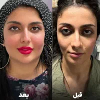 پکیج Face Lift صورت باسن سینه بینی واژن دست ژل لب