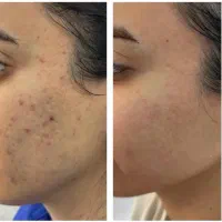 طرح تخفیف فیلر بادی ،ژل و بوتاکس