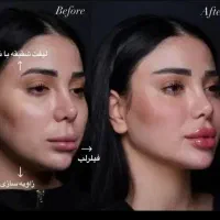 پرسینگ بوتاکس پی آر پی مزو خال با قیمت استثنایی