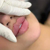 بوتاکس و فیلر و بلفاروپلاستی، لابیاپلاستی