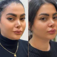 جشنواره فیلر بادی زاویه و کانتور ژل لب روسی بوتاکس