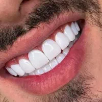 کامپوزیت برزیلی ۱میلیون.عصب کشی وپرکردن باهم ۴تومن