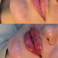 تزریق ژل و فیلر و فشیال خدمات پوستی و سفید کننده