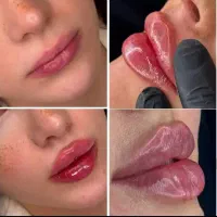 ژل و بوتاکس و لیزر در مطب پزشک با قیمت استثنایی