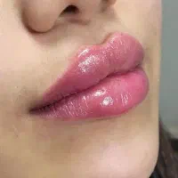 بوتاکس و پک اقتصادی عیدانه زیبایی