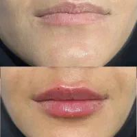 خدمات زیبایی بوتاکس فیلر pro