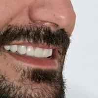 دندانپزشکی زیبایی لمینیت کامپوزیت