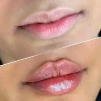 تخفیف تزریق بوتاکس ژل لب گونه چونه درکلینیک