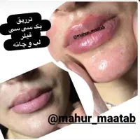 تزریق فیلربوتاکس هایفو لیزرمزو خال درکلینیک ماهور