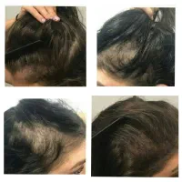 با ریزش موهات و کم پشتی موهات خدافظی کن