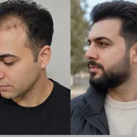 کاشت ممنوع شدش