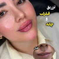 تخفیف آخر تابستان(تزریق فیلر.بوتاکس.پی آرپی )
