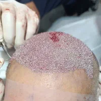 کاشت مو