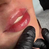 بوتاکس ، لیزر ، کربوکسی تراپی ، مزوتراپی و فیلر