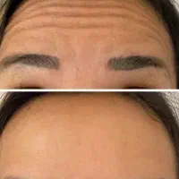 جشنواره تزریق فیلر و بوتاکس گوهردشت