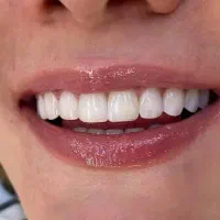 کامپوزیت زیبایی ونیر