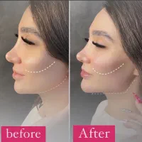 تخفیف‌ ژل لب بوتاکس  مادلینگ زاویه سازی توسط پزشک