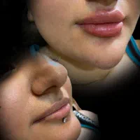 ژل بوتاکس بابهترین کیفیت وقیمت جشنواره لیزرمو زائد