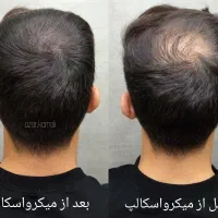 درمان کم پشتی مو