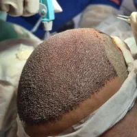 کاشت موی طبیعی فول تراکم یک روزه