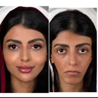 ژل.بوتاکس.فیلر فول فیس.انزیم. پی ارپی یانگ فیس