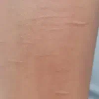 پزشکی. درمان خودزنی و جای زخم