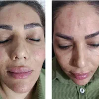 خدمات فیلر و بوتاکس